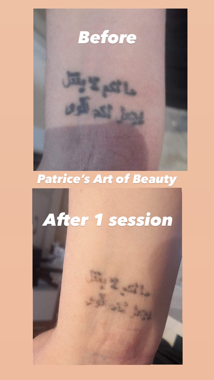 Tattoo Removal - Patrice's Art of Beauty Aesthetics & Laser Clinic